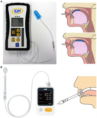 Quantitative evaluation of swallowing function in Parkinson’s disease using tongue pressure measurement: a mini-review